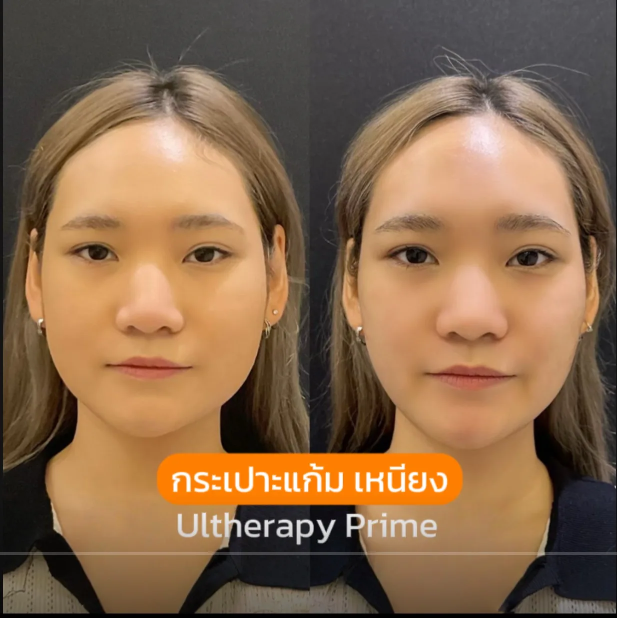 مراجعة Ultherapy PRIME Program وصورة قبل وبعد بموافقة المريض للحالة الحالة 01، قبل وبعد