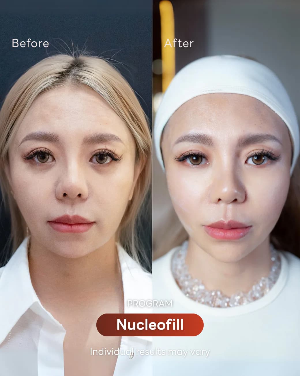 Consented Nucleofill Program review and before-and-after image for Case 01, Before and after