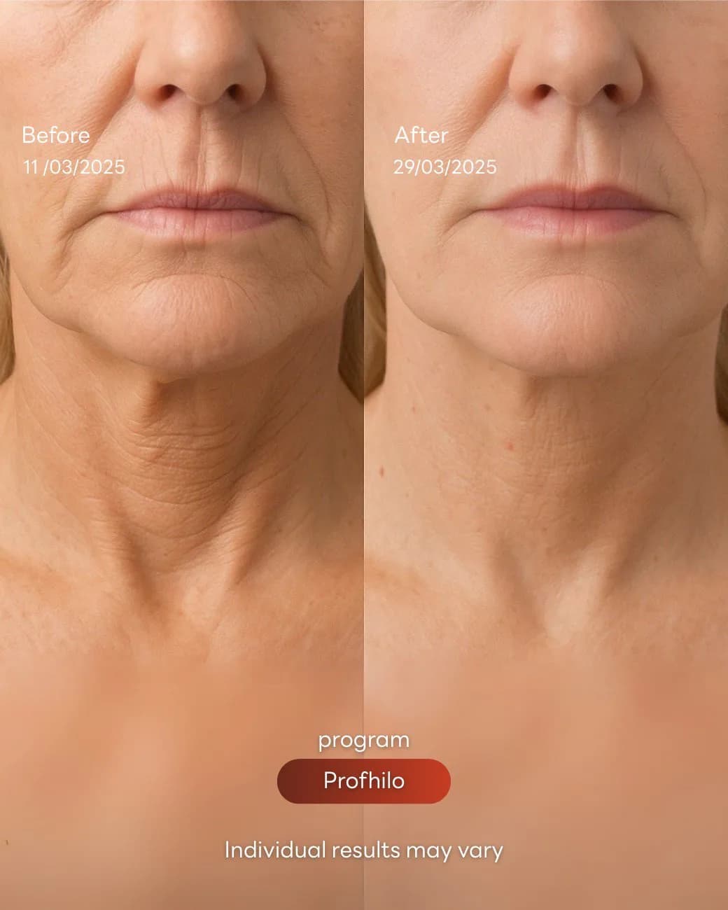 مراجعة Profhilo Bio-Remodelling Program وصورة قبل وبعد بموافقة المريض للحالة الحالة 02، قبل وبعد