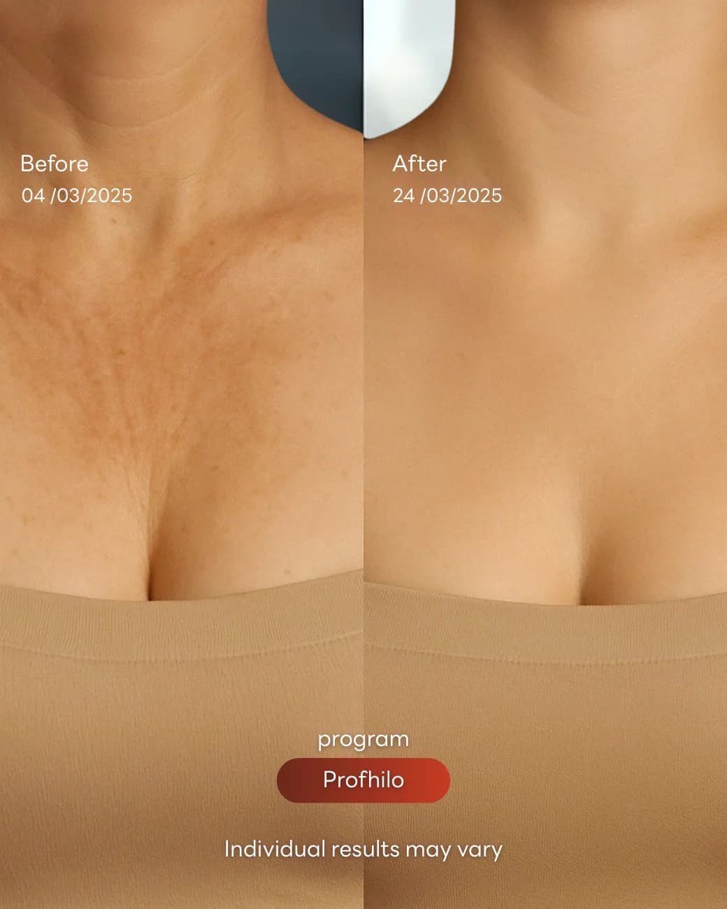 مراجعة Profhilo Bio-Remodelling Program وصورة قبل وبعد بموافقة المريض للحالة الحالة 03، قبل وبعد