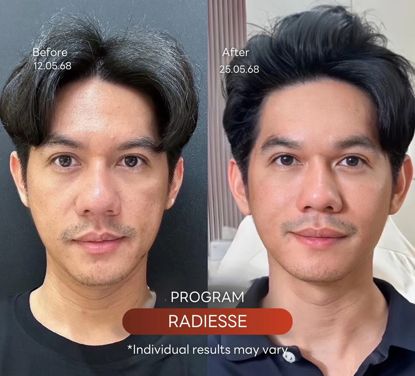 Consented Radiesse Plus Program review and before-and-after image for Case 01, male patient, Before and after