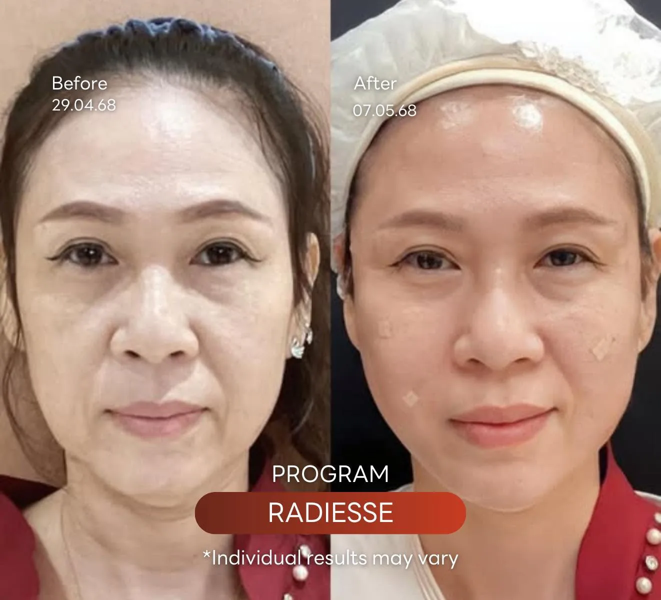 Consented Radiesse Plus Program review and before-and-after image for Case 02, Chinese female patient, Before and after
