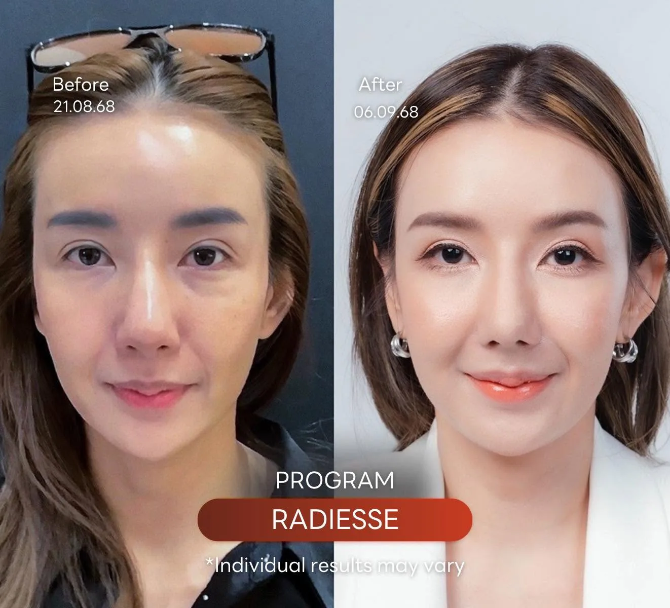 Consented Radiesse Plus Program review and before-and-after image for Case 03, female patient, Before and after