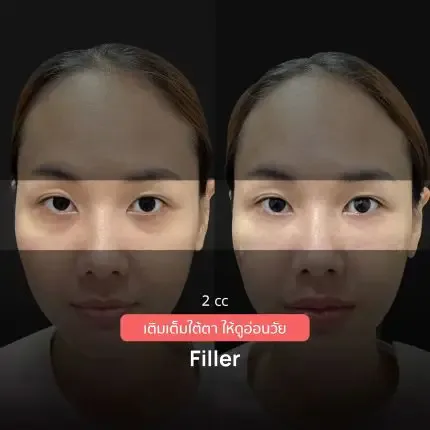 Consented HA Filler Program review and before-and-after image for Case 01, Before and after