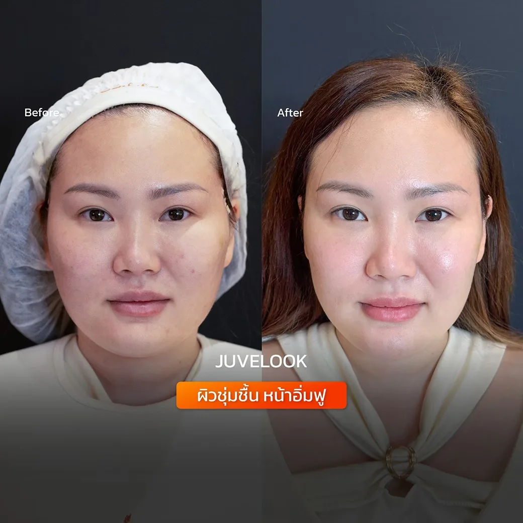 Consented Juvelook Program review and before-and-after image for Case 01, Before and after