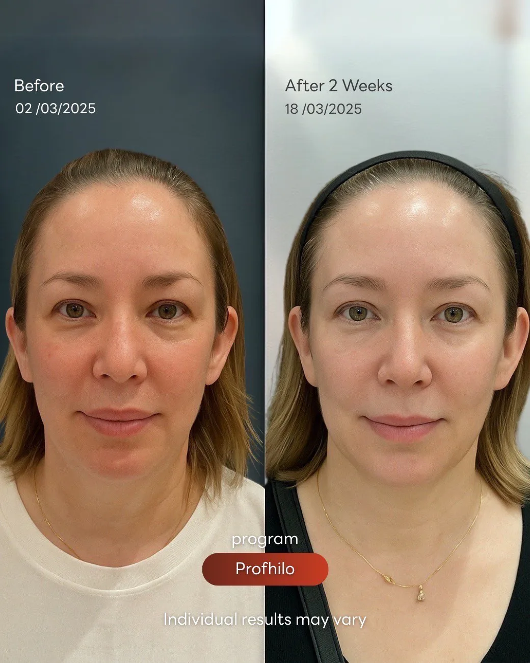 Consented Profhilo Bio-Remodelling Program review and before-and-after image for Case 01, Before and after