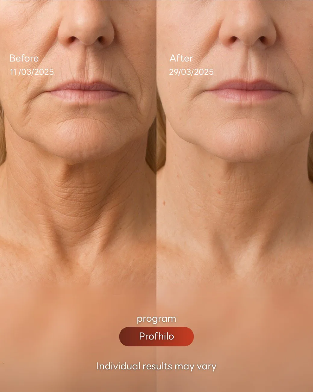Consented Profhilo Bio-Remodelling Program review and before-and-after image for Case 02, Before and after