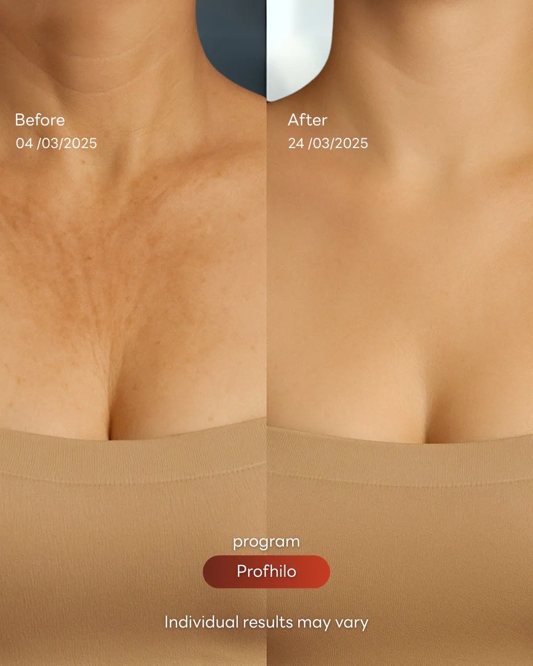 Consented Profhilo Bio-Remodelling Program review and before-and-after image for Case 03, Before and after