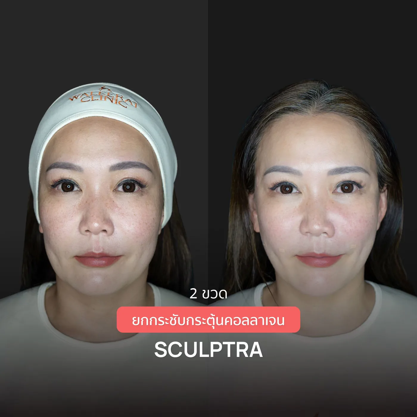 Consented Sculptra Program review and before-and-after image for Case 01, Before and after