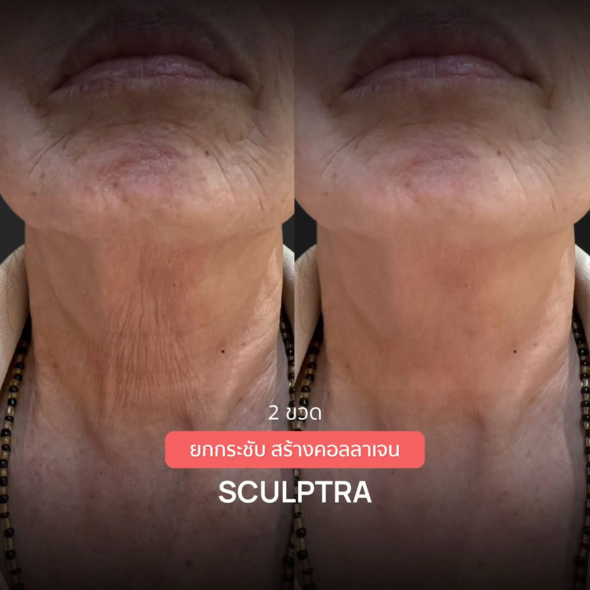Consented Sculptra Program review and before-and-after image for Case 02, Before and after