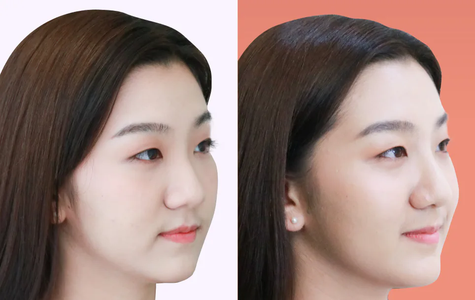 Consented Nose Thread Lift Program review and before-and-after image for Case 01, 45° view