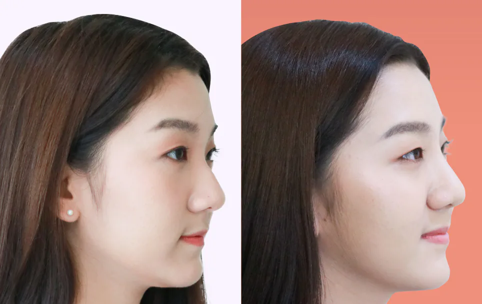 Consented Nose Thread Lift Program review and before-and-after image for Case 01, 90° view