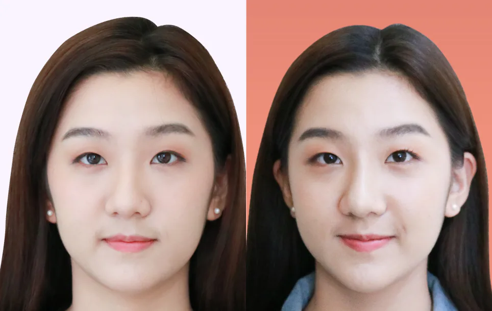Consented Nose Thread Lift Program review and before-and-after image for Case 01, Front view