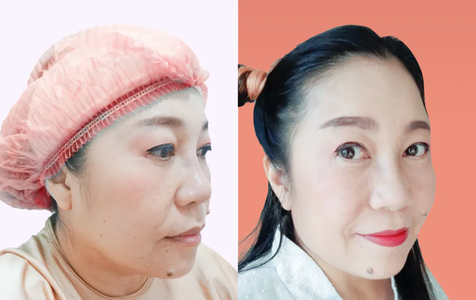 Consented Nose Thread Lift Program review and before-and-after image for Case 02, 45° view