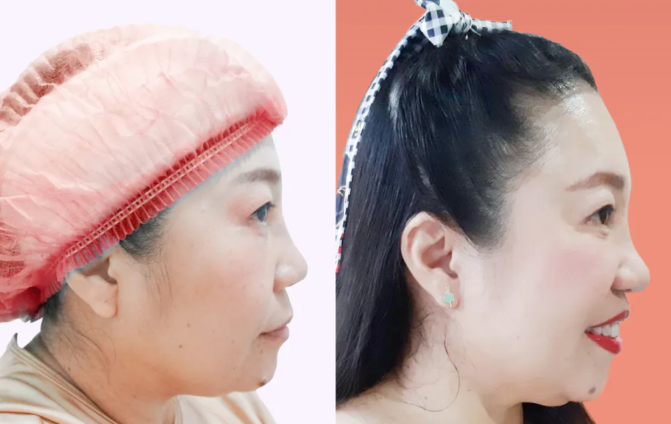 Consented Nose Thread Lift Program review and before-and-after image for Case 02, 90° view