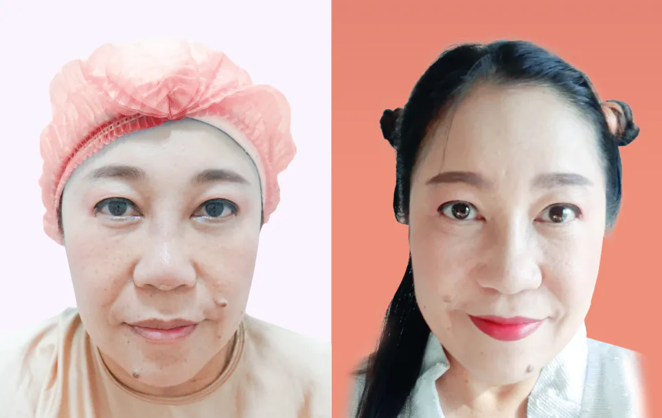 Consented Nose Thread Lift Program review and before-and-after image for Case 02, Front view