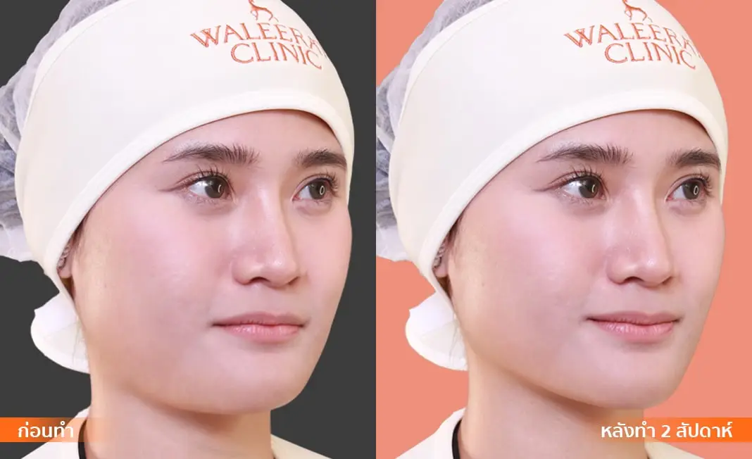 Consented Thread Lift Program review and before-and-after image for One patient, 45° view