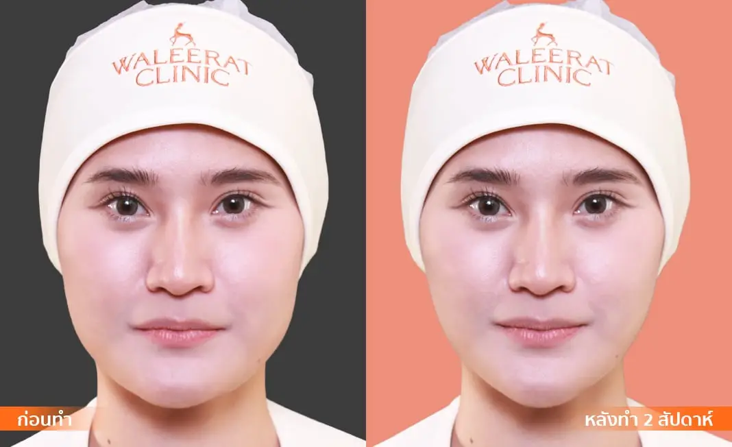 Consented Thread Lift Program review and before-and-after image for One patient, Front view