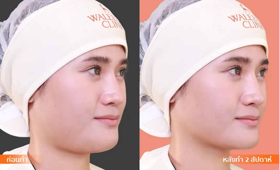 Consented Thread Lift Program review and before-and-after image for One patient, 90° view