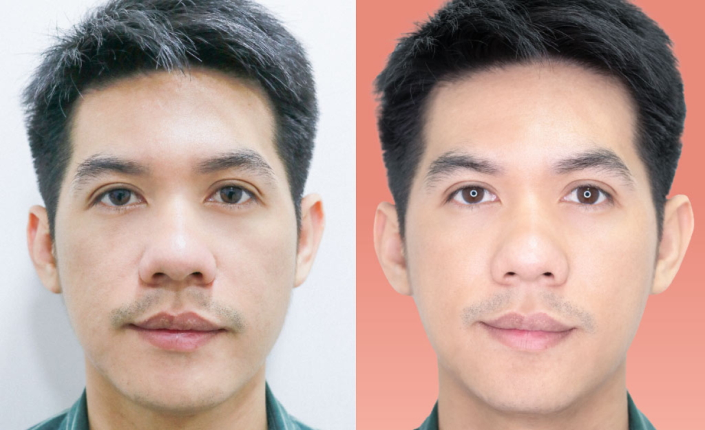 รีวิวก่อน-หลังร้อยไหม ruby no.5