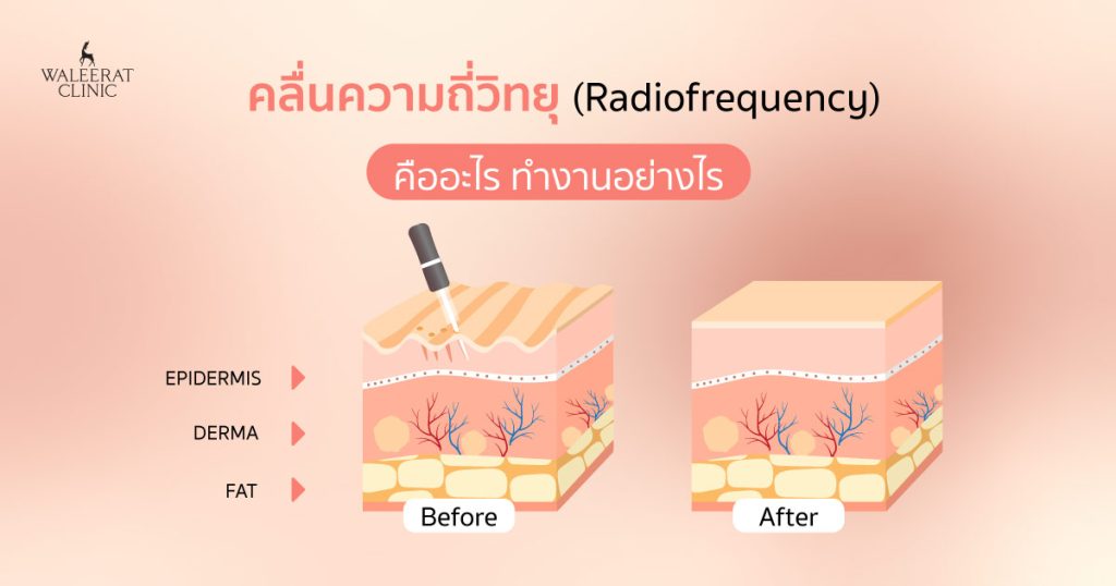 คลื่นความถี่วิทยุ (Radiofrequency) คืออะไร ทำงานอย่างไร