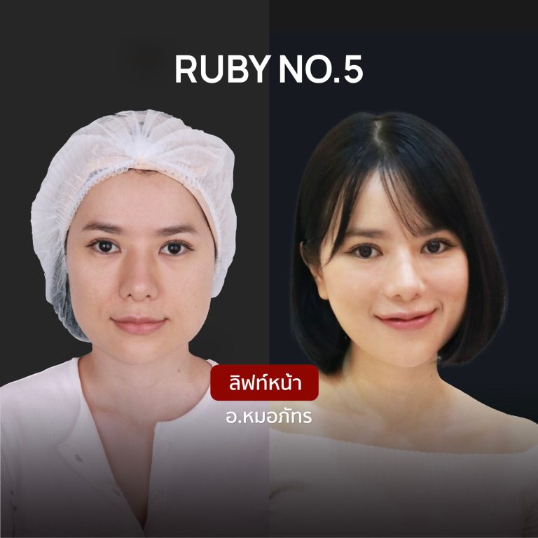 ภาพเปรียบเทียบ Ruby No.5