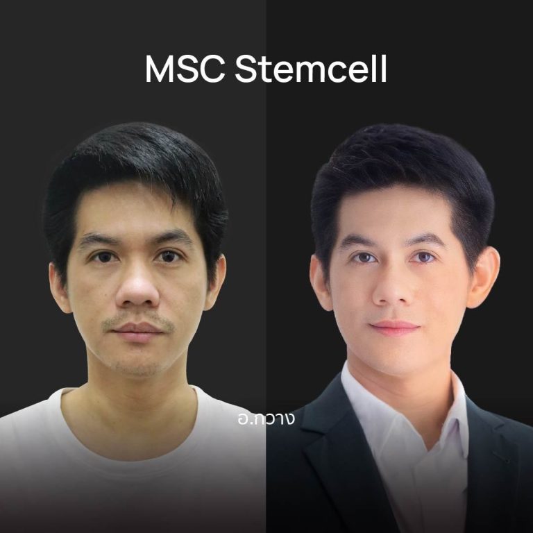 รีวิวฉีดสเต็มเซลล์ MSC Stemcell เคสผู้ชาย
