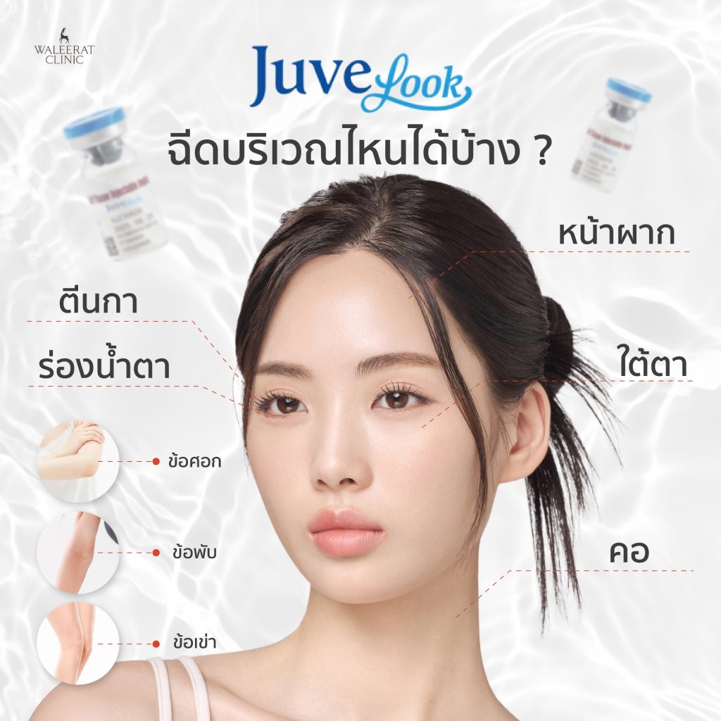 Juvelook ฉีดบริเวณไหนบ้าง