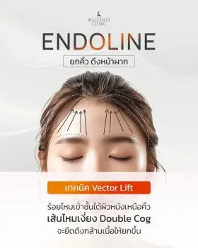 ร้อยไหม Endoline ทดแทนศัลยกรรม Endotine