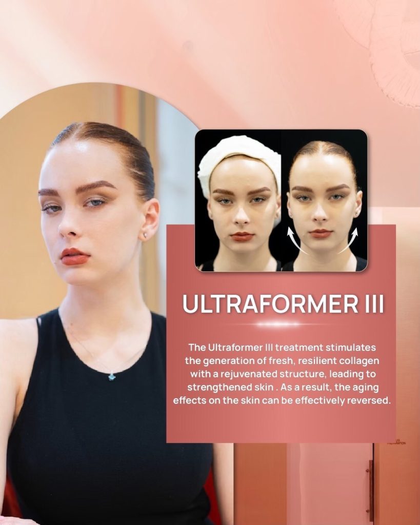 Ultraformer III Treatment